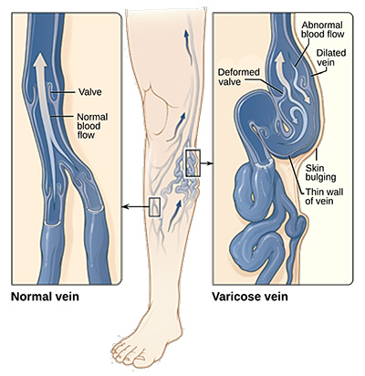 What are Varicose Veins?