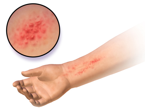 How To Treat Dermatitis
