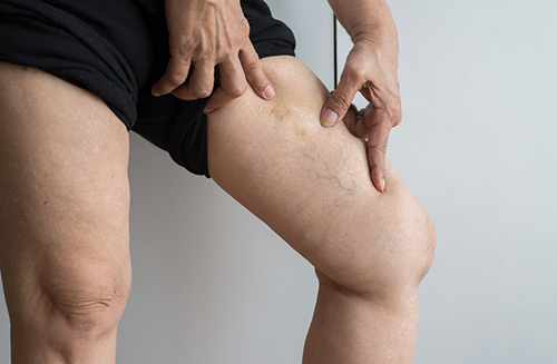 person pointing to left leg showing varicose veins