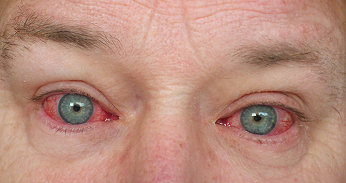 someone with bloodshot eyes