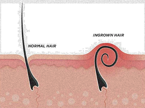 ingrown hair image explanation