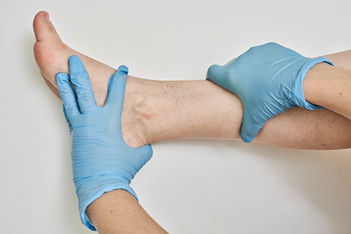 doctor examining varicose veins