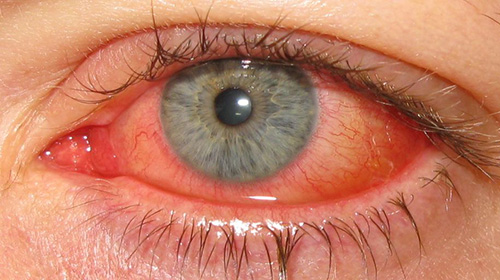 eye of someone suffering from conjunctivitis