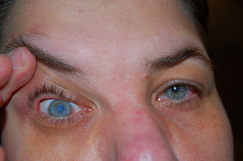 woman suffering from corneal ulcer
