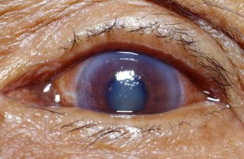eye of someone suffering from glaucoma