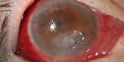corneal ulcers