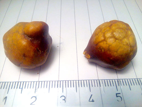 two different sizes of gallstones