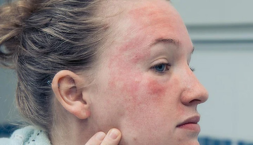 woman with eczema on her face