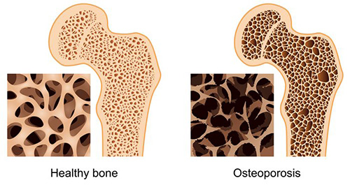 healthy bone side by side with a bone suffering from osteoporosis