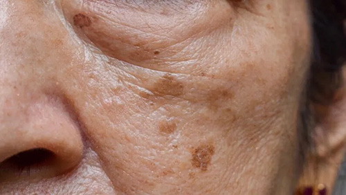 the close up of a woman's face with age spots