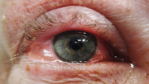 What Can Be Mistaken for Pink Eye