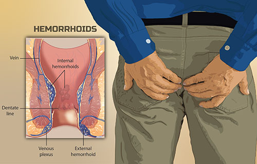 Neosporin for Hemorrhoids