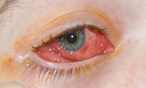 someone's eye suffering from conjunctivitis